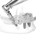 Dental Implant