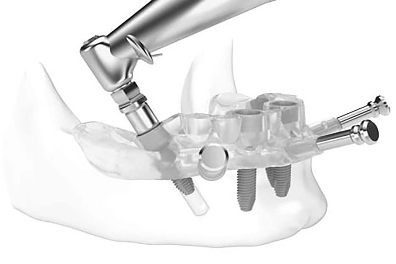 Dental Implant
