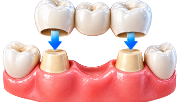 Dental Bridge