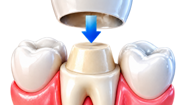 Dental Crown