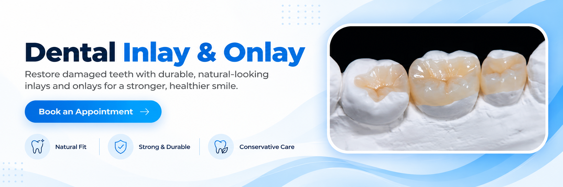 Dental Inlay & Onlay