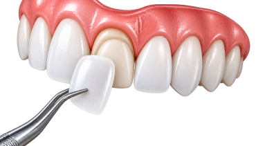 Dental Veneers