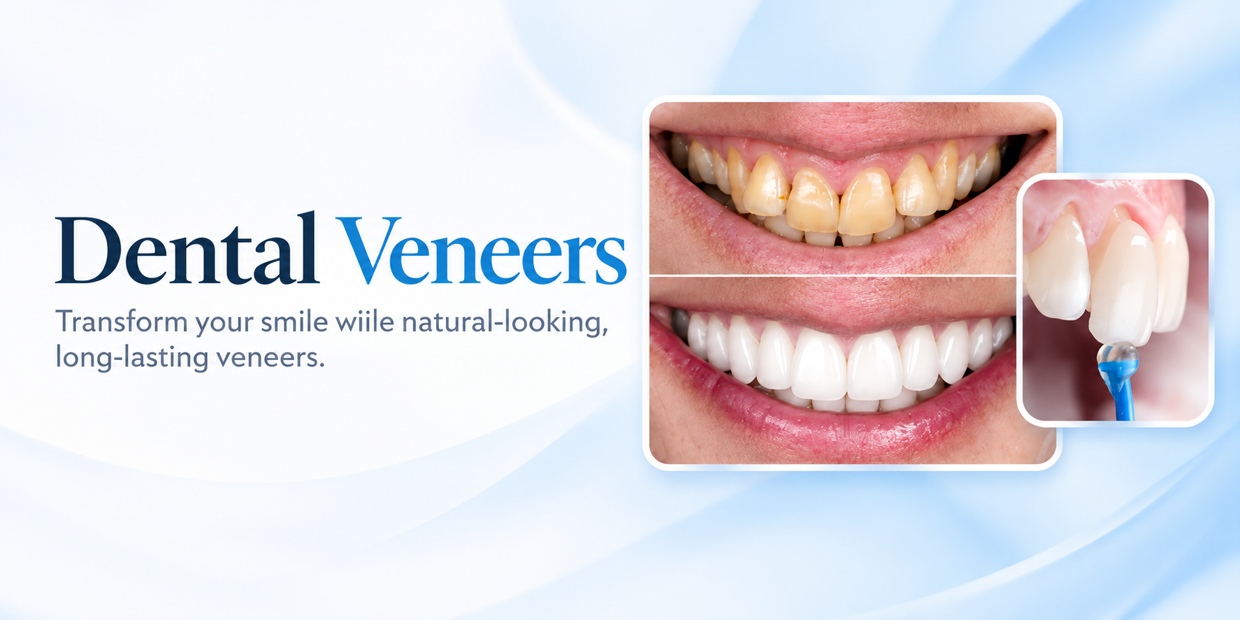 Dental Veneers