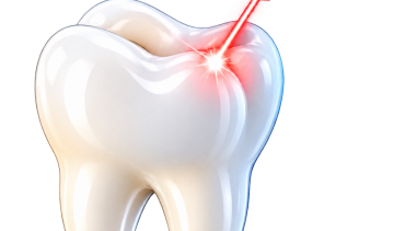 Laser Dentistry