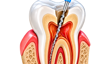 Root Canal Treatment