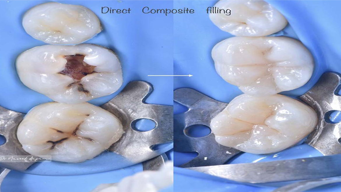 Tooth Filling