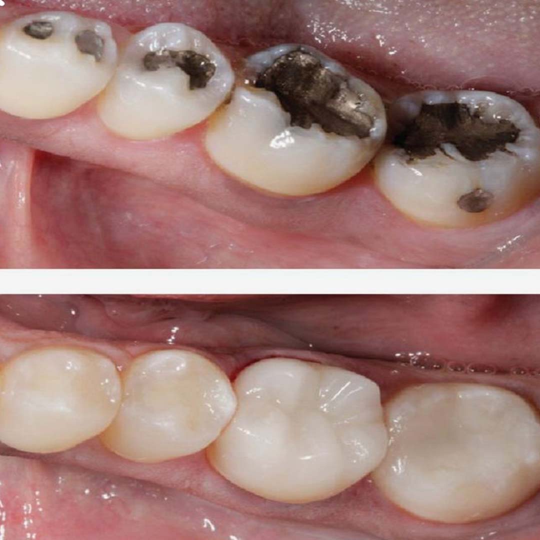 Tooth Filling